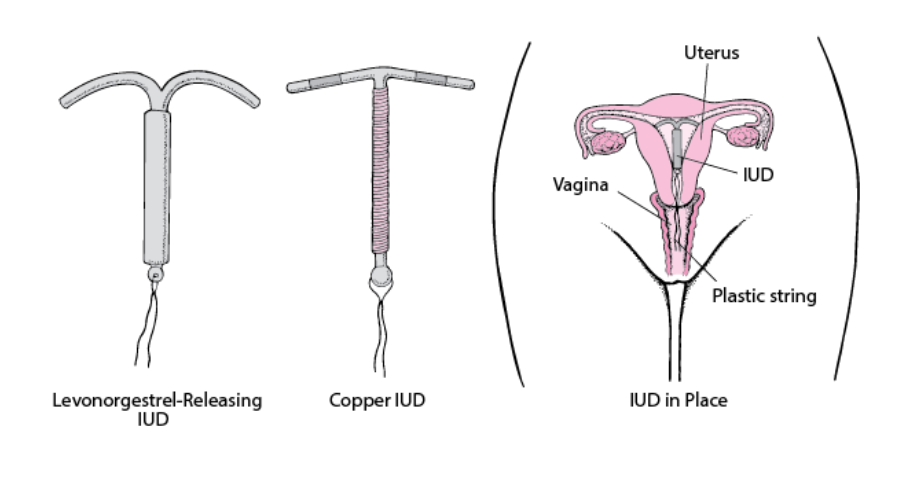 Types of Intrauterine Devices