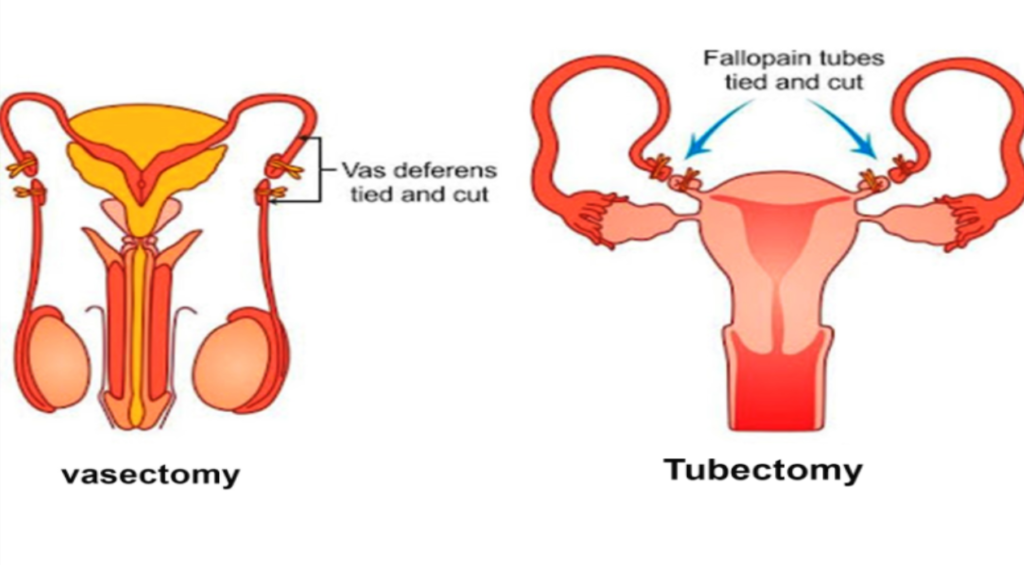 Types of Sterilization